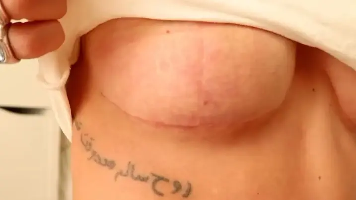 Cicatriz en T de operación mastopexia de Laura Casabela