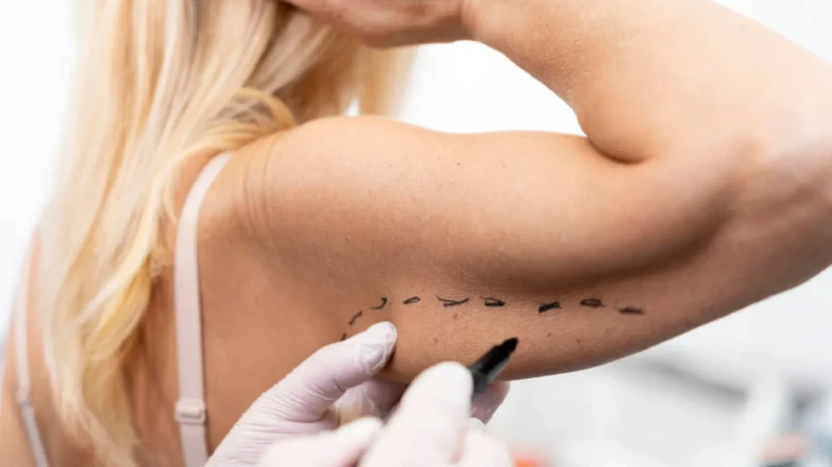 Lifting de brazos completo