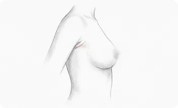 Aumento de pecho via aixilar