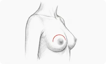 Aumento de pecho via periorelar