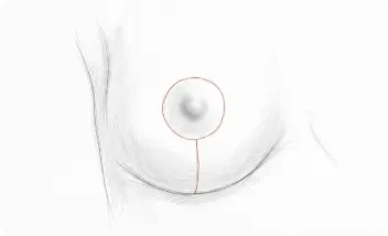 mastopexia elevacion lolipop