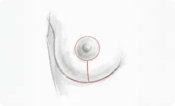 mastopexia elevacion t invertida