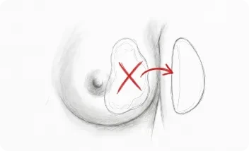 substitución de prótesis mamarias